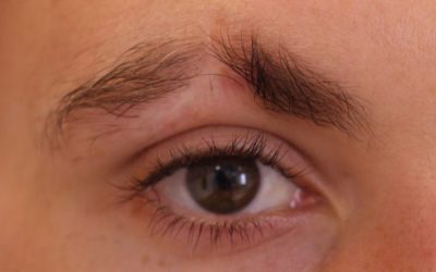 Male Brow Loss – Have you thought about Medical Tattooing?