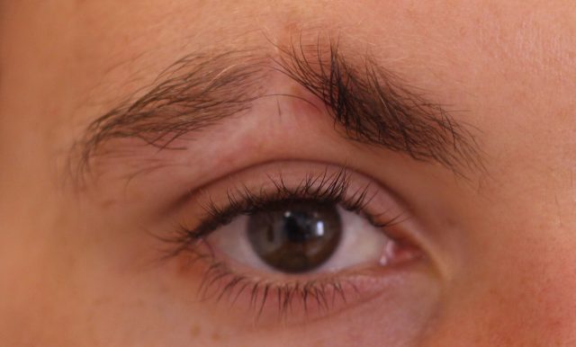 Male Brow Loss – Have you thought about Medical Tattooing?