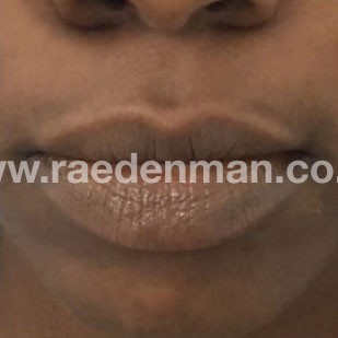 medical tattooing patchy lips before