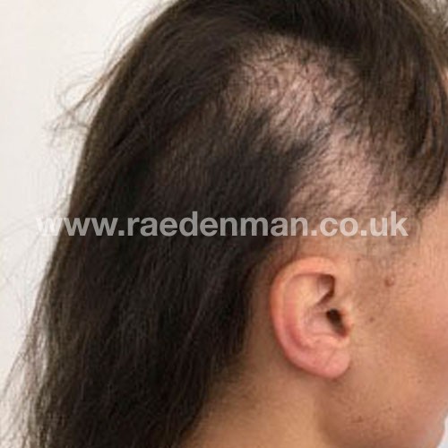 hair loss medical tattoo before