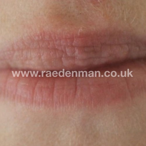 medical tattooing patchy lips before