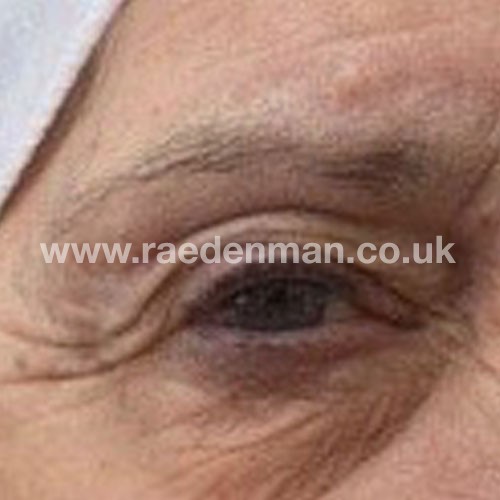 eyebrow medical tattoo before