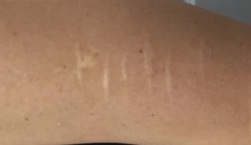 Cover Self Harm Scars - Camouflage Consultations