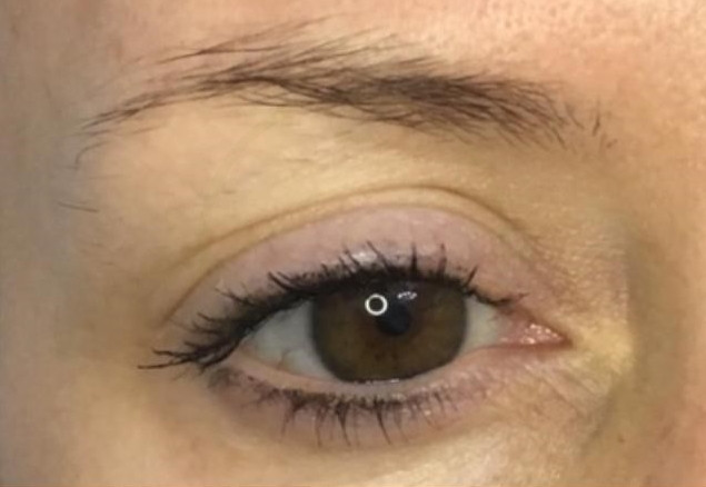 eyebrow medical tattoo before