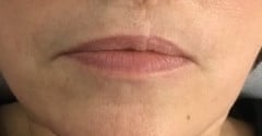 medical tattooing patchy lips before