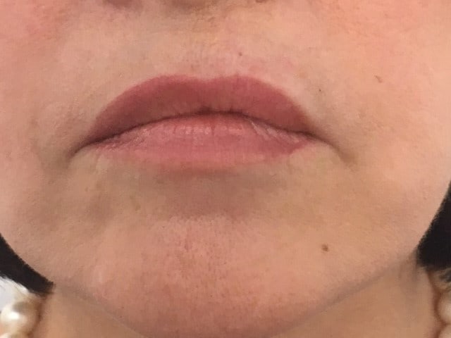 medical tattooing patchy lips before