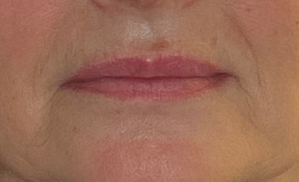 medical tattooing patchy lips before