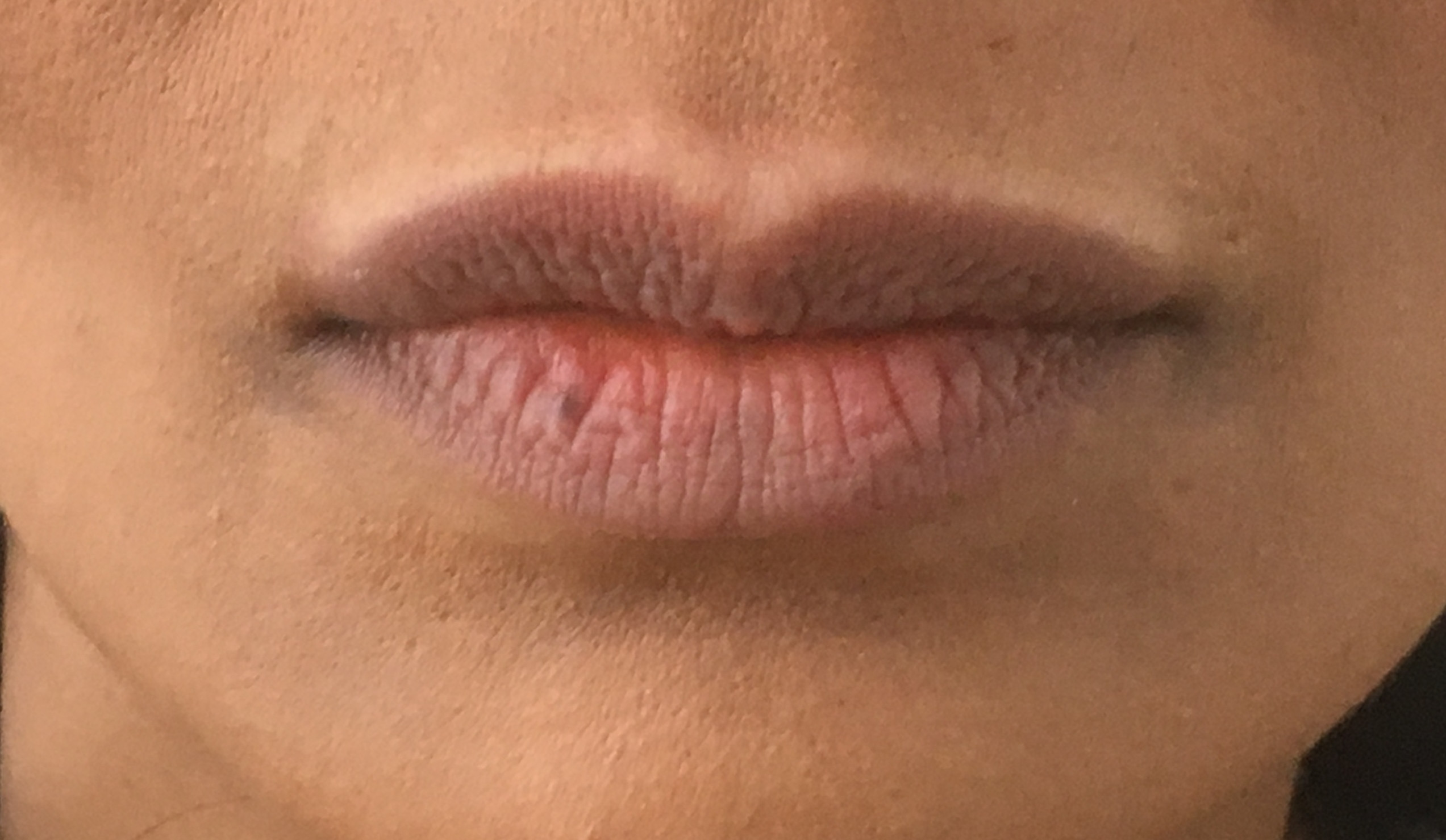 medical tattooing patchy lips before