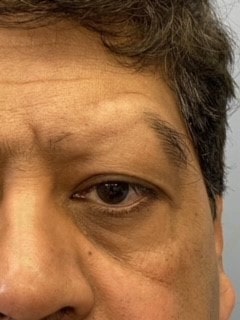 eyebrow medical tattoo before