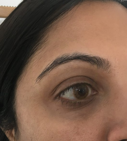 eyebrow medical tattoo before