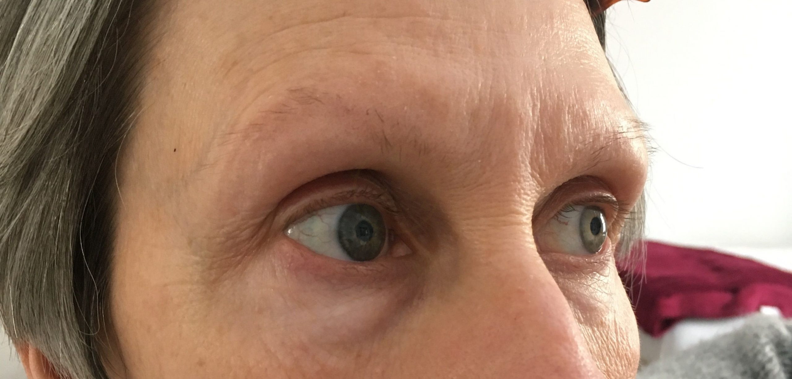 eyebrow medical tattoo before