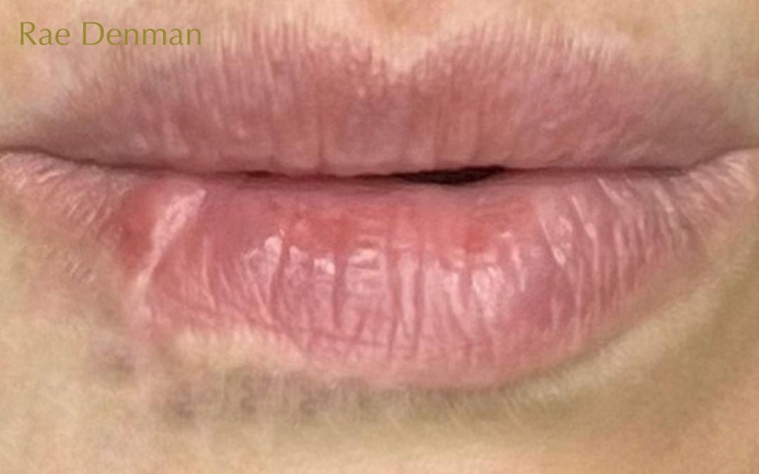 Improve lip scars with Medical Tattooing