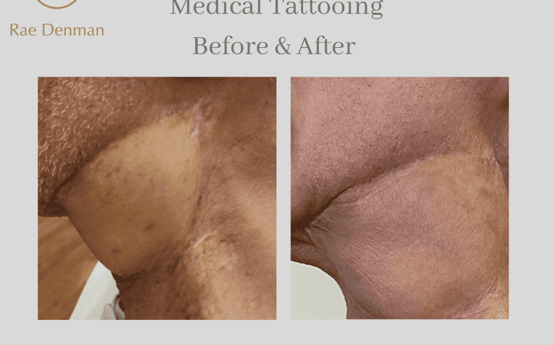 Medical Tattooing Following A Skin Graft