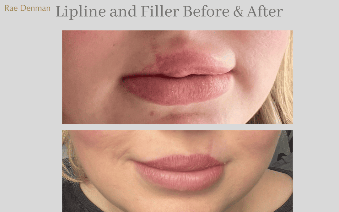 Medical Tattooing for lips to add definition and a cupids bow