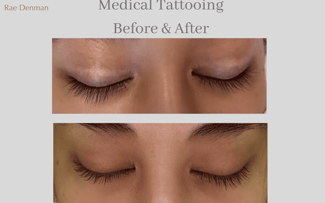 Medical Tattooing For Blepharoplasty Surgery Scarring