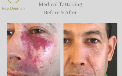 Medical Tattooing for lips to add definition and a cupids bow - Rae Denman