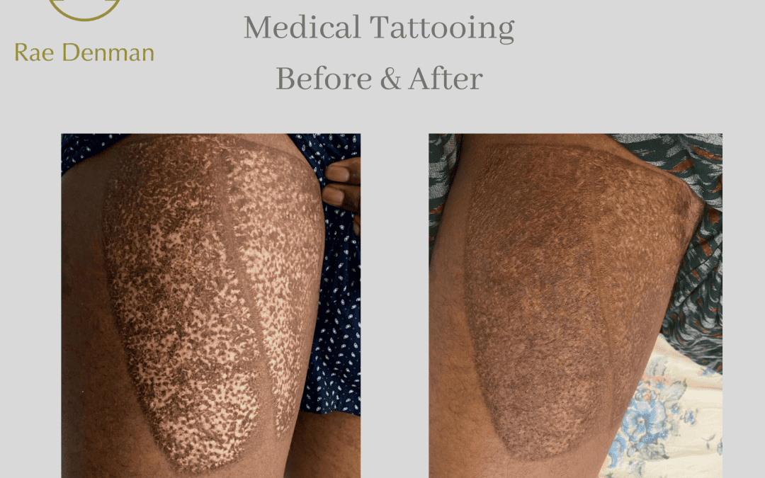 Blending a Skin Graft site using Medical Tattooing