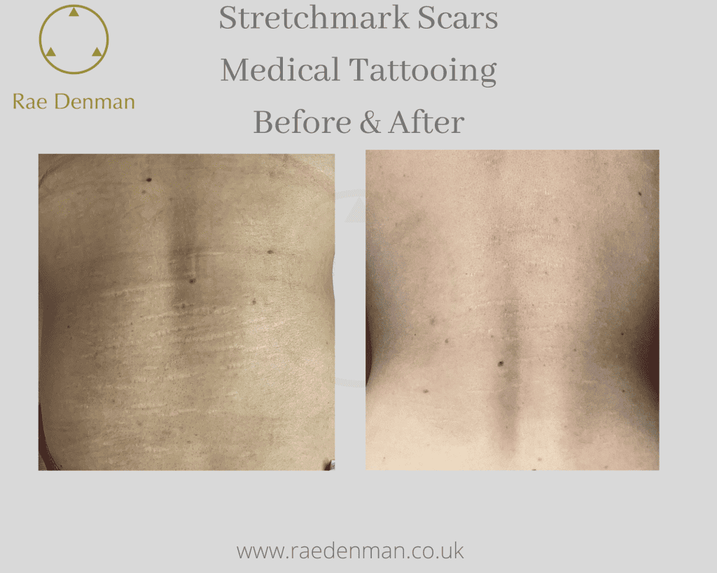 What can I do about Stretchmarks