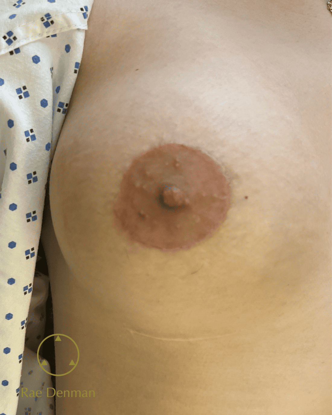 Nipple Tattoo Surrey After