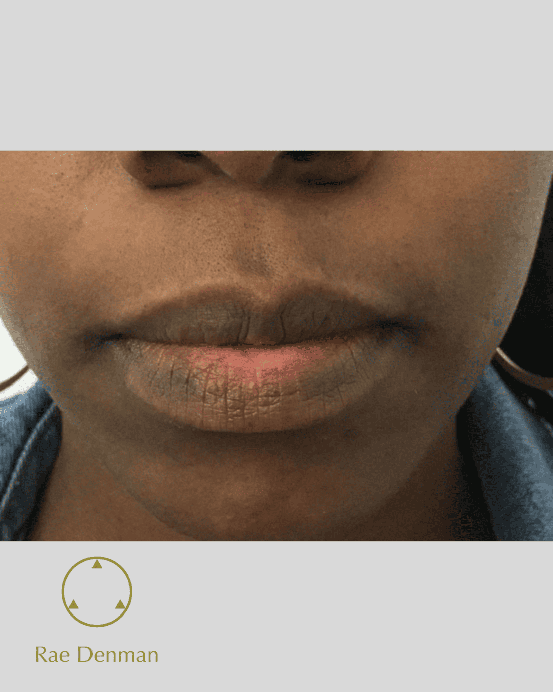 Hypopigmentation