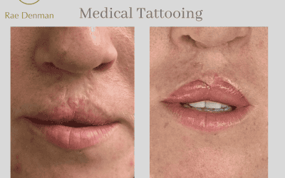 The Role of Medical Tattooing in Cleft Lip Reconstruction